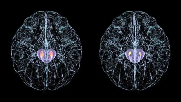 El síntoma silencioso del Parkinson que suele pasar desapercibido durante años