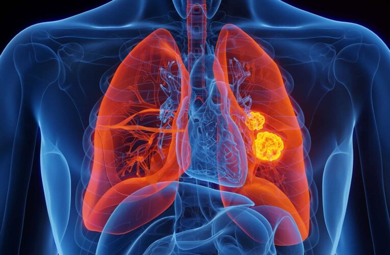 Cáncer de pulmón en personas que nunca fumaron: la enfermedad que preocupa cada vez más a los científicos